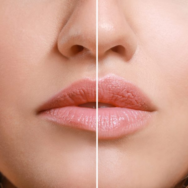 Hyaloron-Lippenvergrößerung